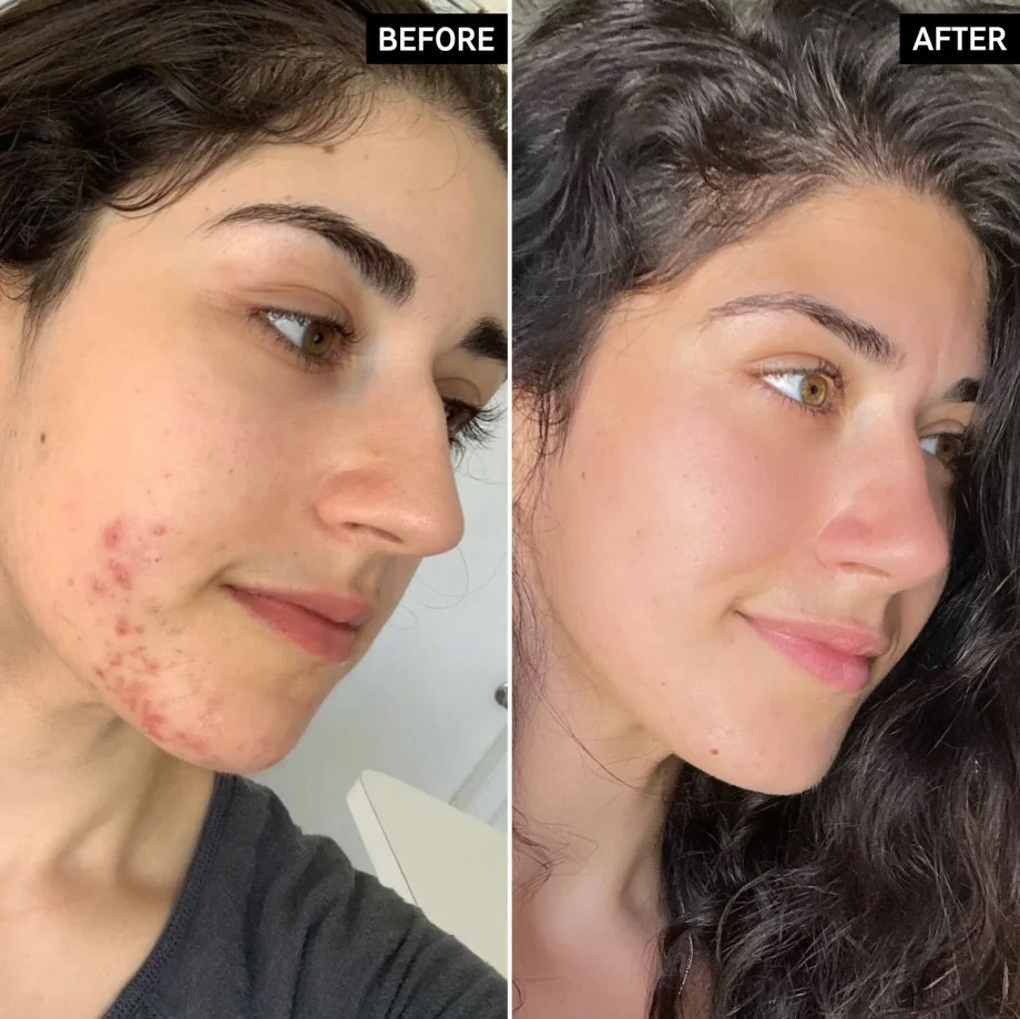 The Inkey List Intro Routine for Acne